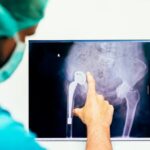 Advancements in Hip Replacement Techniques and Recovery