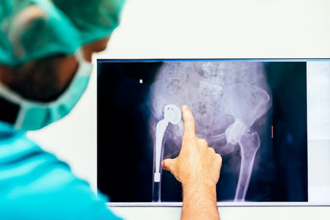 Advancements in Hip Replacement Techniques and Recovery