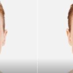 Botox vs. Fillers and What You Need to Know