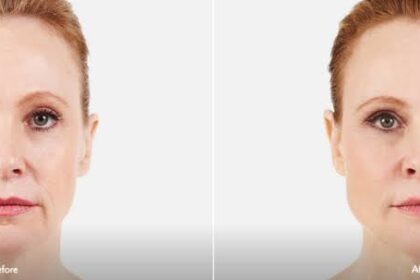 Botox vs. Fillers and What You Need to Know