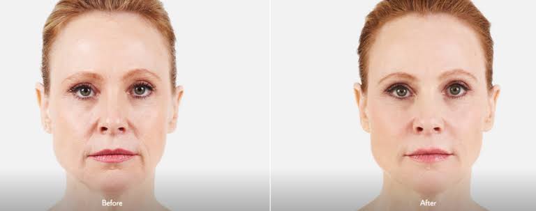 Botox vs. Fillers and What You Need to Know