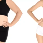 Common Questions and Answers About Weight Loss Surgery