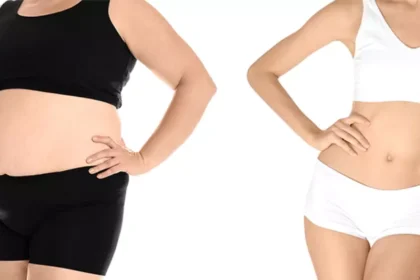 Common Questions and Answers About Weight Loss Surgery