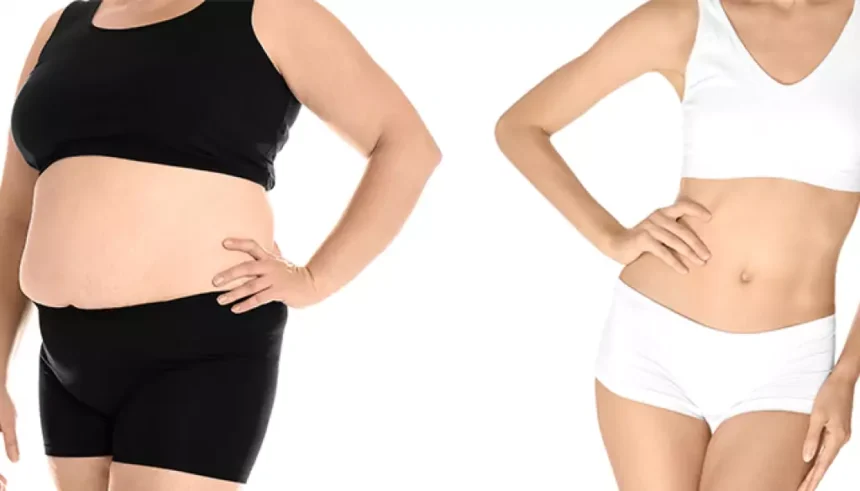 Common Questions and Answers About Weight Loss Surgery