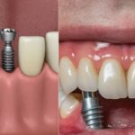 Exploring the Different Types of Dental Implants