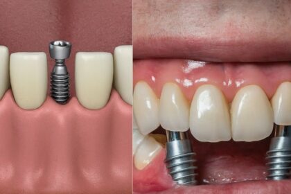 Exploring the Different Types of Dental Implants