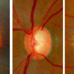 Exploring the Different Types of Glaucoma