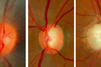 Exploring the Different Types of Glaucoma