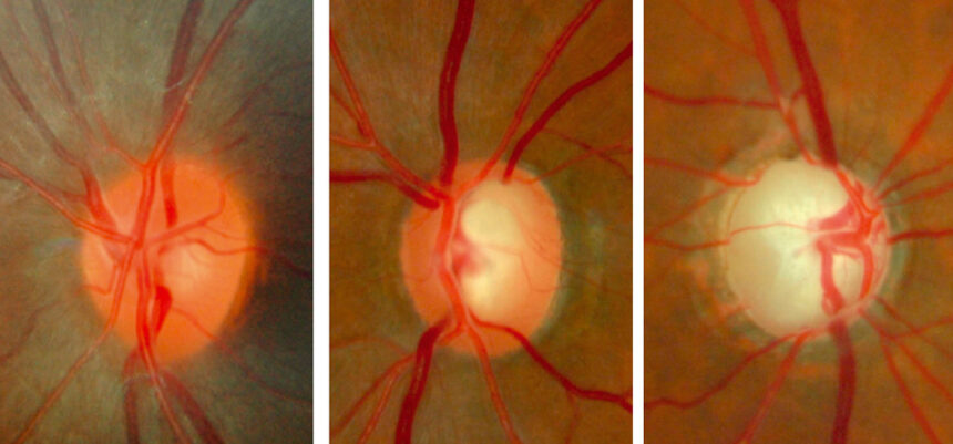 Exploring the Different Types of Glaucoma