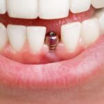 Exploring the Role of Dental Implants in Cosmetic Dentistry