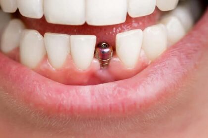 Exploring the Role of Dental Implants in Cosmetic Dentistry