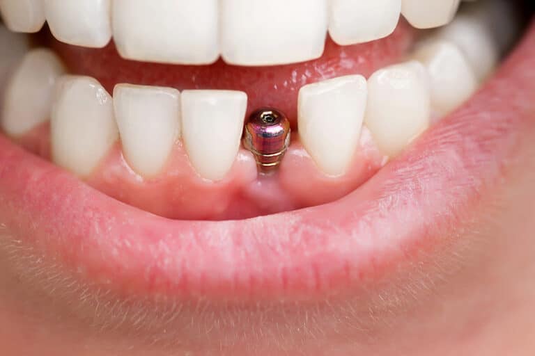 Exploring the Role of Dental Implants in Cosmetic Dentistry
