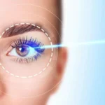 Frequently Asked Questions About Lasik