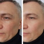 How Botox Works To Reduce the Appearance of Wrinkles