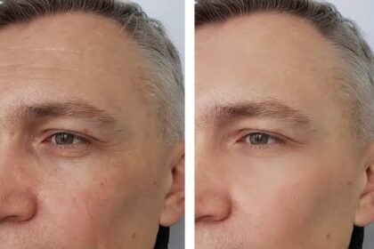 How Botox Works To Reduce the Appearance of Wrinkles