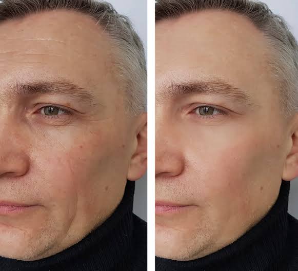 How Botox Works To Reduce the Appearance of Wrinkles