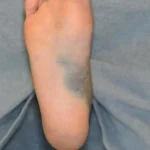 How To Identify and Treat Infected Ankle Wounds