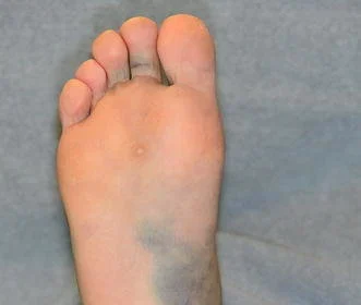 How To Identify and Treat Infected Ankle Wounds