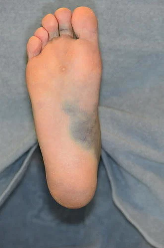 How To Identify and Treat Infected Ankle Wounds