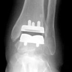 How To Prepare for Ankle Replacement Surgery