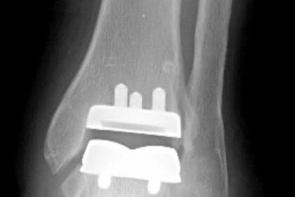 How To Prepare for Ankle Replacement Surgery