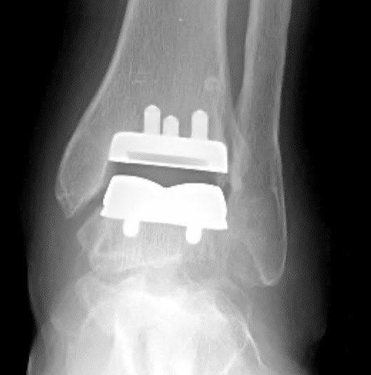 How To Prepare for Ankle Replacement Surgery