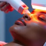 Laser Genesis as a Non-Invasive Solution for Acne Scarring