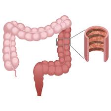 Lifestyle Changes To Help With Ulcerative Colitis