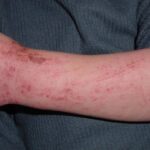 Questions To Ask Your Dermatologist About Eczema Treatment
