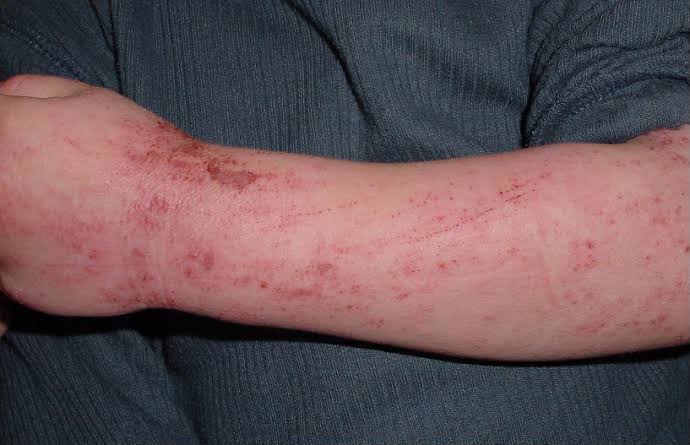 Questions To Ask Your Dermatologist About Eczema Treatment