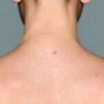 Recognizing Early Signs of Skin Cancer
