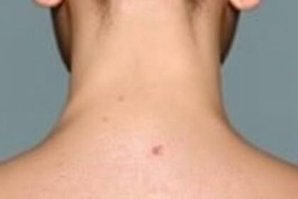 Recognizing Early Signs of Skin Cancer