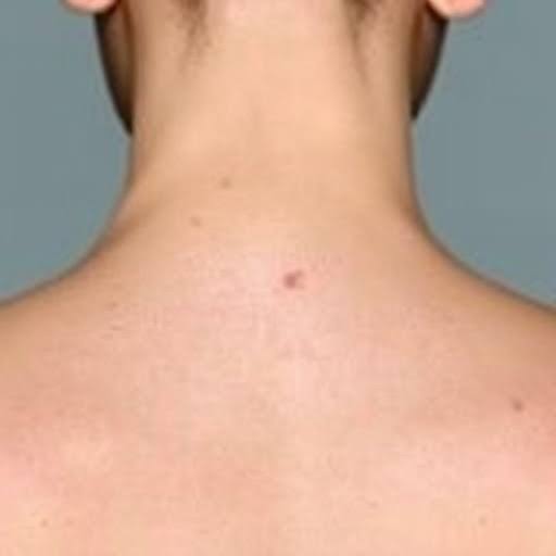 Recognizing Early Signs of Skin Cancer