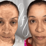 Revitalizing Your Skin With Morpheus8