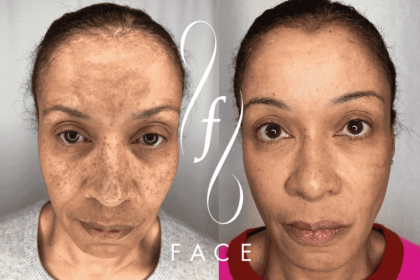 Revitalizing Your Skin With Morpheus8