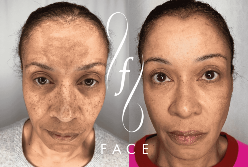 Revitalizing Your Skin With Morpheus8