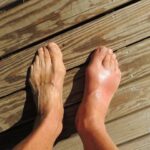 The Connection Between Plantar Fasciitis and Flat Feet