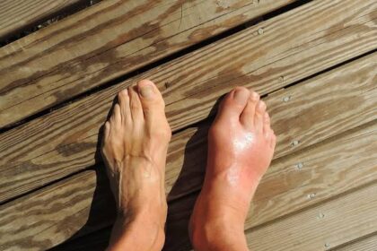 The Connection Between Plantar Fasciitis and Flat Feet