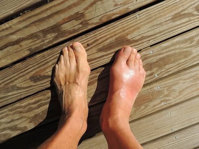 The Connection Between Plantar Fasciitis and Flat Feet