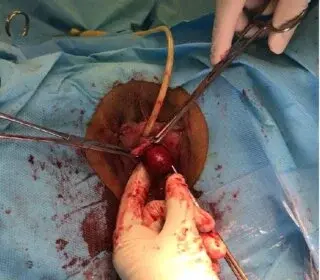 The Surgical Techniques Used in Gallbladder Removal