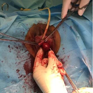 The Surgical Techniques Used in Gallbladder Removal