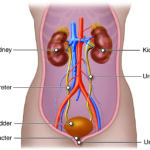 Understanding Causes and Prevention of Kidney Stones