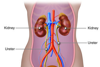 Understanding Causes and Prevention of Kidney Stones