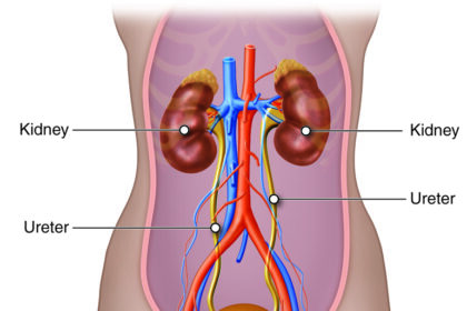Understanding Causes and Prevention of Kidney Stones