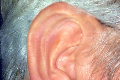 Understanding Ear Infection Symptoms in Adults