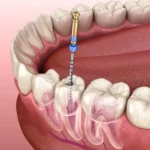 Understanding the Signs That You May Need a Root Canal