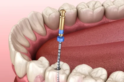 Understanding the Signs That You May Need a Root Canal