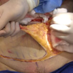 Understanding the Tummy Tuck Procedure