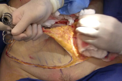 Understanding the Tummy Tuck Procedure