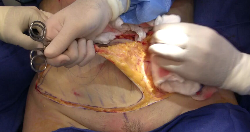 Understanding the Tummy Tuck Procedure